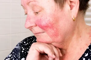 How to Manage and Treat Rosacea