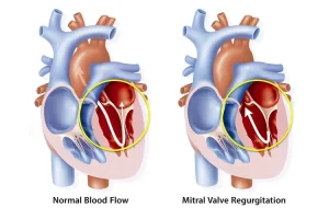 What Is Mitral Valve Regurgitation?