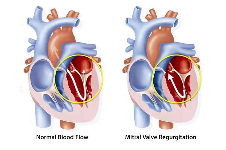 What Is Mitral Valve Regurgitation?
